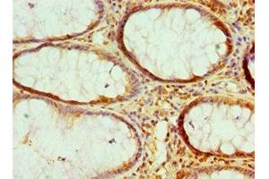 Immunohistochemistry of paraffin-embedded human colon cancer using ABIN7161681 at dilution of 1:100 (HMGN2 抗体  (AA 1-90))