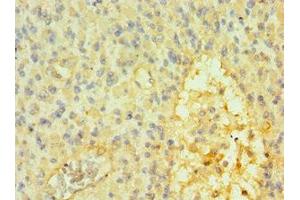 Immunohistochemistry of paraffin-embedded human glioma using ABIN7172610 at dilution of 1:100 (SOX14 抗体  (AA 91-240))