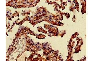 Immunohistochemistry of paraffin-embedded human lung cancer using ABIN7143899 at dilution of 1:100 (alpha-Mannosidase II 抗体  (AA 31-181))