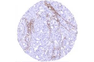 Serous high grade carcinoma of the ovary showing decorin staining of the stroma (Recombinant Decorin 抗体  (AA 212-336))