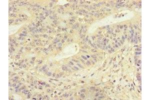 Immunohistochemistry of paraffin-embedded human colon cancer using ABIN7153118 at dilution of 1:100