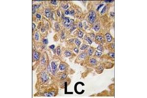 Formalin-fixed and paraffin-embedded human lung carcinoma tissue reacted with AKT2 Antibody , which was peroxidase-conjugated to the secondary antibody, followed by DAB staining.