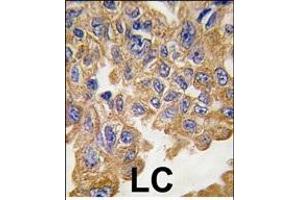 Formalin-fixed and paraffin-embedded human lung carcinoma tissue reacted with AKT2 Antibody , which was peroxidase-conjugated to the secondary antibody, followed by DAB staining. (AKT2 抗体  (AA 452-481))