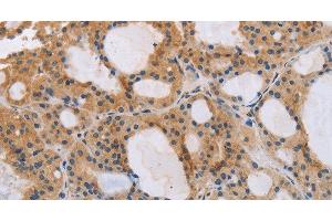 Immunohistochemistry of paraffin-embedded Human thyroid cancer tissue using ITPR1 Polyclonal Antibody at dilution 1:40 (ITPR1 抗体)