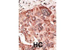 Formalin-fixed and paraffin-embedded human hepatocellular carcinoma tissue reacted with RCVRN polyclonal antibody  , which was peroxidase-conjugated to the secondary antibody, followed by DAB staining. (Recoverin 抗体  (C-Term))