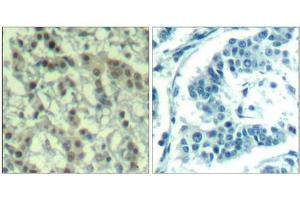 Immunohistochemical analysis of paraffin-embedded human breast carcinoma tissue using Aurora A(Phospho-Thr288) Antibody(left) or the same antibody preincubated with blocking peptide(right).