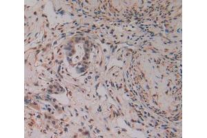 Used in DAB staining on fromalin fixed paraffin- embedded pancreas cancer tissue (PAK2 抗体  (AA 177-419))