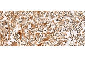 Immunohistochemistry of paraffin-embedded Human liver cancer tissue using GCC2 Polyclonal Antibody at dilution of 1:45(x200) (GCC2 抗体)