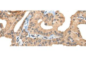 Immunohistochemistry of paraffin-embedded Human thyroid cancer tissue using BHMT2 Polyclonal Antibody at dilution of 1:30(x200) (BHMT2 抗体)