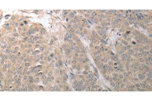 Immunohistochemistry of paraffin-embedded Human liver cancer using SLC1A4 Polyclonal Antibody at dilution of 1:70 (SLC1A4 抗体)