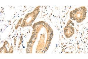 Immunohistochemistry of paraffin-embedded Human colon cancer using TSPAN13 Polyclonal Antibody at dilution of 1:35 (TSPAN13 抗体)