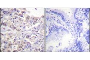 Immunohistochemistry analysis of paraffin-embedded human lung carcinoma, using hnRPD (Phospho-Ser83) Antibody. (HNRNPD/AUF1 抗体  (pSer83))