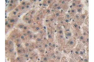 Detection of CHI3L1 in Human Liver cancer Tissue using Polyclonal Antibody to Chitinase-3-like Protein 1 (CHI3L1)