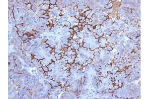 Formalin-fixed, paraffin-embedded human Ovarian Carcinoma stained with MUC16 Mouse Monoclonal Antibody (5E11). (MUC16 抗体)