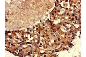 Immunohistochemistry of paraffin-embedded human breast cancer using ABIN7171581 at dilution of 1:100 (TBP 抗体  (AA 1-55))