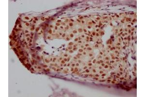 IHC image of ABIN7127589 diluted at 1:100 and staining in paraffin-embedded human breast cancer performed on a Leica BondTM system. (Recombinant JunB 抗体)