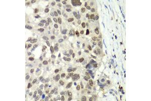 Immunohistochemistry of paraffin-embedded human esophageal cancer using E2F6 antibody (ABIN6290326) at dilution of 1:100 (40x lens). (E2F6 抗体)