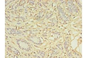Immunohistochemistry of paraffin-embedded human breast cancer using ABIN7149384 at dilution of 1:100 (AGBL2 抗体  (AA 10-270))