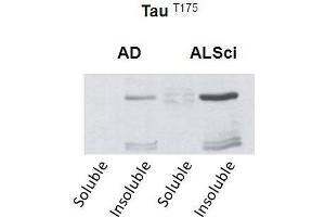 Western blot detection of insoluble phospho-Tau protein using the anti-Tau (Thr-175) antibody in samples isolated from patients with a neurodegenerative disease (Amyotropic lateral sclerosis, ALS or Alzheimer’s disease, AD (tau 抗体  (pThr175))