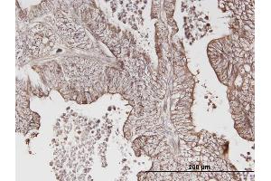 Immunoperoxidase of monoclonal antibody to ERBB3 on formalin-fixed paraffin-embedded human lung cancer. (ERBB3 抗体  (AA 21-331))