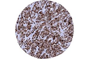 Strong cytoplasmic PMEL immunostaining in all cells of a malignant melanoma of the skin (Recombinant Melanoma gp100 抗体)