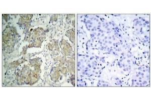 Immunohistochemical analysis of paraffin-embedded human breast carcinoma tissue using VEGFR2(Phospho-Tyr1214) Antibody(left) or the same antibody preincubated with blocking peptide(right). (VEGFR2/CD309 抗体  (pTyr1214))