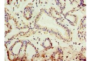 Immunohistochemistry of paraffin-embedded human breast cancer using ABIN7157726 at dilution of 1:100 (KLF3 抗体  (AA 1-240))