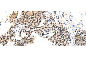 Immunohistochemistry of paraffin-embedded Human liver cancer tissue using MAGEA6 Polyclonal Antibody at dilution 1:120 (MAGEA6 抗体)