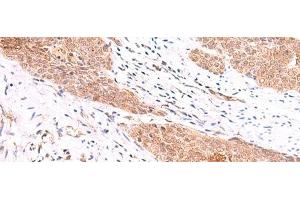 Immunohistochemistry of paraffin-embedded Human esophagus cancer tissue using COPS3 Polyclonal Antibody at dilution of 1:60(x200) (COPS3 抗体)