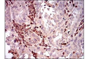 Immunohistochemical analysis of paraffin-embedded endometrial cancer tissues using CD68 mouse mAb with DAB staining. (CD68 抗体  (AA 42-155))