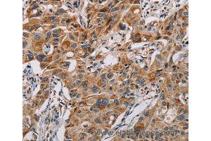 Immunohistochemistry of Human lung cancer using MMP1 Polyclonal Antibody at dilution of 1:60 (MMP1 抗体)