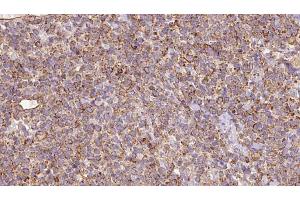 ABIN6273184 at 1/100 staining Human lymph cancer tissue by IHC-P. (SLC22A12 抗体)