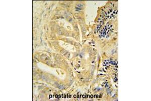 TLL1 antibody immunohistochemistry analysis in formalin fixed and paraffin embedded human prostate carcinoma followed by peroxidase conjugation of the secondary antibody and DAB staining. (TLL1 抗体  (C-Term))