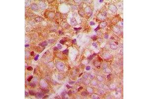Immunohistochemical analysis of ACBD6 staining in human breast cancer formalin fixed paraffin embedded tissue section. (ACBD6 抗体)