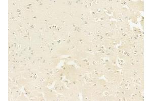 ABIN6262584 and ABIN6278144 at 1/100 staining human glioblastoma by IHC-P.