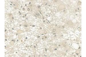 ABIN6257759 and ABIN6274371 at 1/100 staining human astrocytoma by IHC-P. (MED1 抗体  (C-Term))