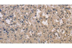 Immunohistochemistry of paraffin-embedded Human thyroid cancer using DRG1 Polyclonal Antibody at dilution of 1:30 (DRG1 抗体)
