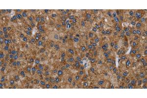 Immunohistochemistry of paraffin-embedded Human liver cancer tissue using NECTIN2 Polyclonal Antibody at dilution 1:40 (PVRL2 抗体)