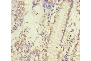 Immunohistochemistry of paraffin-embedded human colon cancer using ABIN7159632 at dilution of 1:100 (MCCC1 抗体  (AA 526-725))