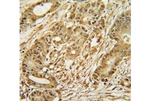 MCM2 antibody immunohistochemistry analysis in formalin fixed and paraffin embedded human colon carcinoma. (MCM2 抗体  (AA 649-677))