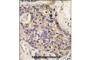 Formalin-fixed and paraffin-embedded human hepatocarcinoma tissue reacted with HGF antibody (C-term) (ABIN388462 and ABIN2848889) , which was peroxidase-conjugated to the secondary antibody, followed by DAB staining. (HGF 抗体  (C-Term))