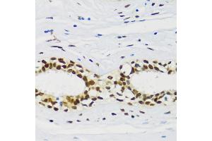 Immunohistochemistry of paraffin-embedded human breast cancer using CIRBP antibody (ABIN6129747, ABIN6138627, ABIN6138629 and ABIN6221699) at dilution of 1:100 (40x lens). (CIRBP 抗体  (AA 1-172))