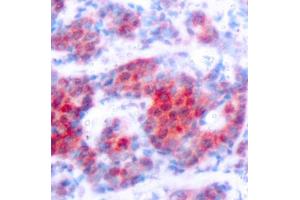 Immunohistochemistry of paraffin-embedded human breast carcinoma using Phospho-ST-Y693 antibody (ABIN3019610, ABIN3019611, ABIN3019612, ABIN1682083 and ABIN1682084). (STAT4 抗体  (pTyr693))