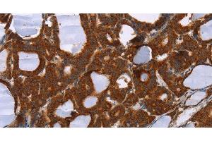 Immunohistochemistry of paraffin-embedded Human thyroid cancer tissue using PPP2R3C Polyclonal Antibody at dilution 1:30 (PPP2R3C 抗体)