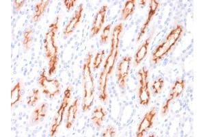 Formalin-fixed, paraffin-embedded human Renal Cell Carcinoma stained with CD137L-Monospecific Mouse Monoclonal Antibody (CD137L/1547).
