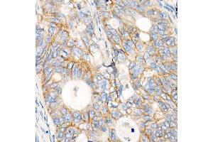 Immunohistochemistry of paraffin-embedded human colon carcinoma using MRP1/ antibody (ABIN7265736) at dilution of 1:100 (40x lens). (ABCC1 抗体)