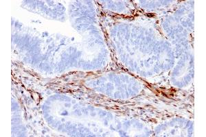 Formalin-fixed, paraffin-embedded human Colon Carcinoma stained with Nestin Mouse Monoclonal Antibody (NES/2911). (Nestin 抗体  (AA 698-844))