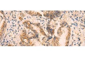 Immunohistochemistry of paraffin-embedded Human cervical cancer tissue using CRYM Polyclonal Antibody at dilution of 1:65(x200) (CRYM 抗体)