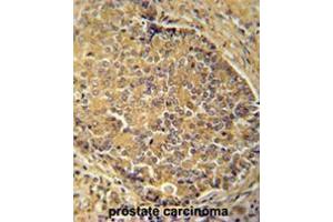 IGSF1 antibody (C-term) immunohistochemistry analysis in formalin fixed and paraffin embedded human prostate carcinoma followed by peroxidase conjugation of the secondary antibody and DAB staining. (IGSF1 抗体  (C-Term))