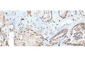 Immunohistochemistry of paraffin-embedded Human thyroid cancer tissue using SMC1A Polyclonal Antibody at dilution of 1:30(x200) (SMC1A 抗体)